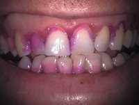 Zähne mit 4-facher Vergrößerung, nach Anfärben mit einem Plaquefärbemittel. Alle violetten Beläge rund um die Zähne sind Bakterien, die schon längere Zeit durch Zähneputzen nicht mehr entfernt wurden.