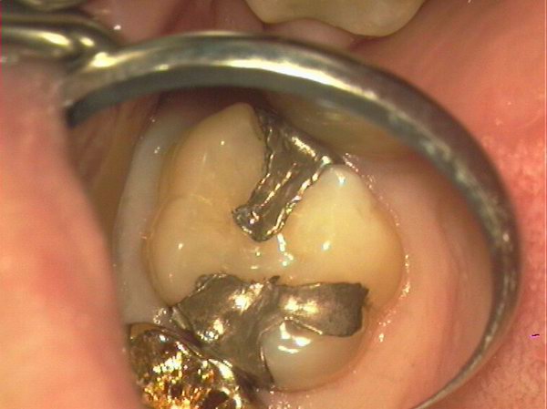 Zahn mit Amalgamfuellung Mikroskop Vergroesserung